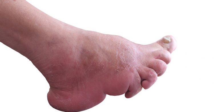 Pieds d'une femme chinoise de 97 ans (Istock)